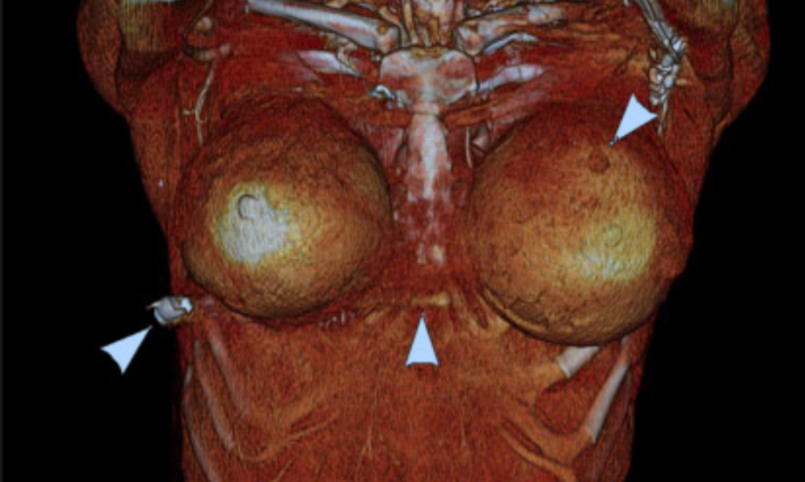 Doctors Say Woman's Breast Implants Changed Trajectory of Bullet