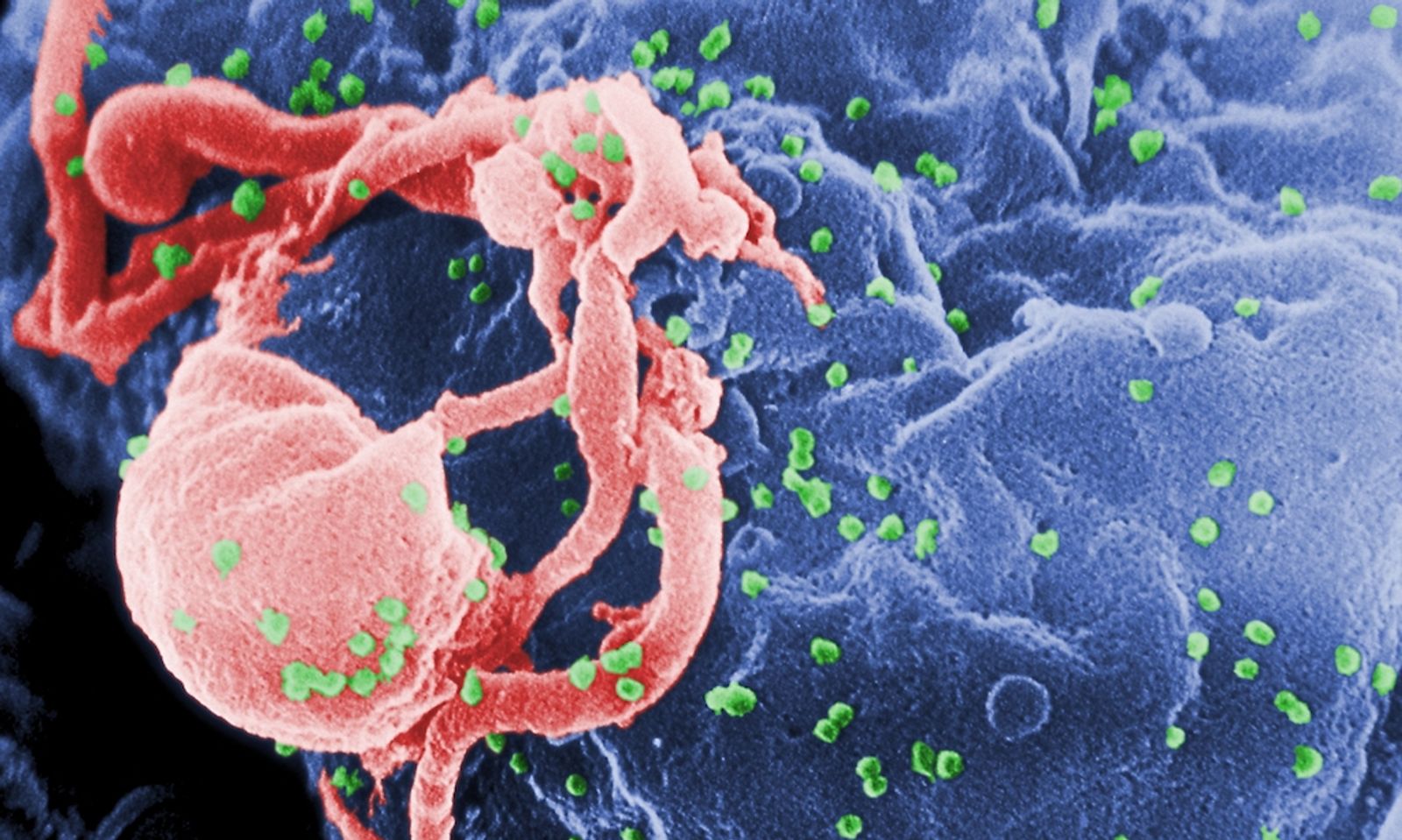 2nd HIV Patient Reportedly Clear of Virus After Stem Cell Therapy